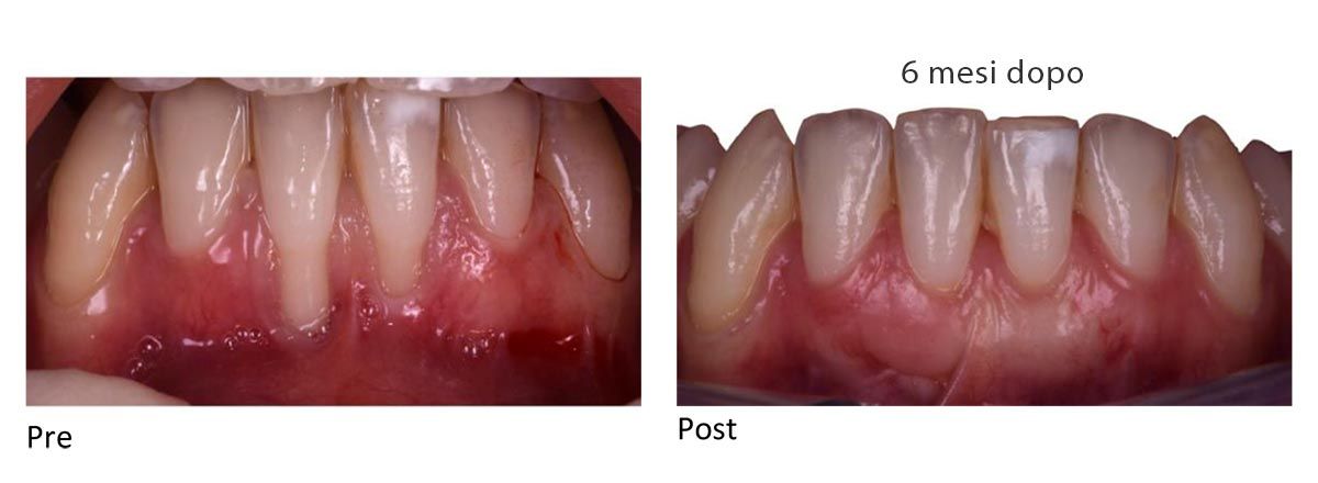 Cosa è la chirurgia mucogengivale