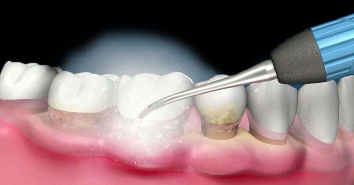In cosa consiste la Terapia Causale?