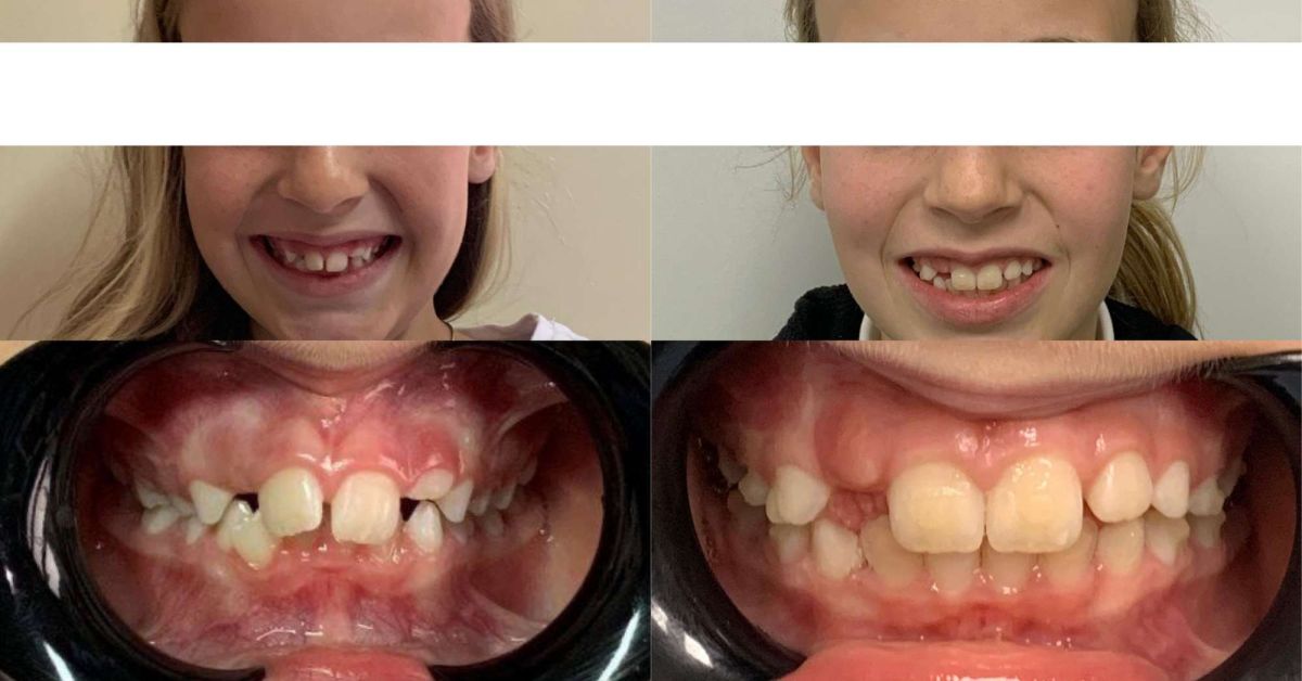Contenzioni ortodontiche, a cosa servono?