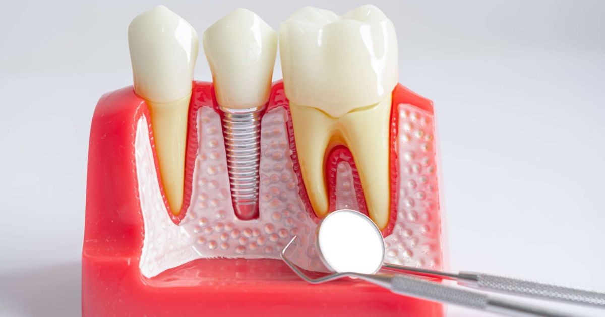 Impianti Dentali e Parodontite: Cosa Dicono Davvero le Linee Guida Internazionali?