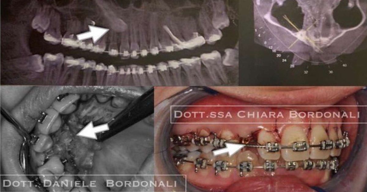 CASO CLINICO: ESTRUSIONE CHIRURGICA ORTODONTICA DI UN CANINO INCLUSO