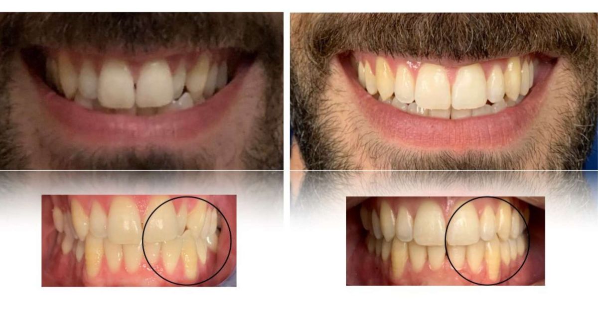 TRATTAMENTO CON ORTODONZIA INVISIBILE