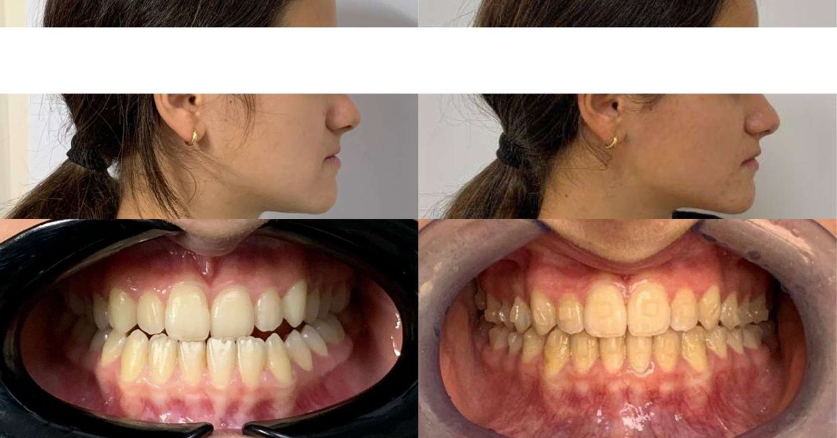 CASO STUDIO: MALOCCLUSIONE DI CLASSE III