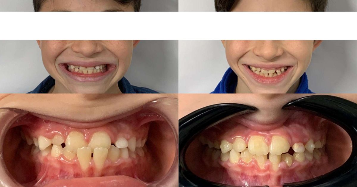 CASO STUDIO: trattamento ortodontico intercettivo con allineatori invisibili.
