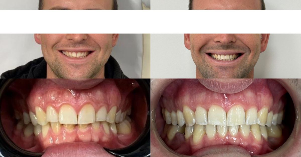 caso studio: terapia ortodontica invisibile con allineatori