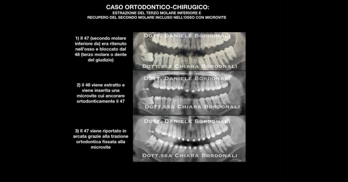CASO STUDIO MICROVITE